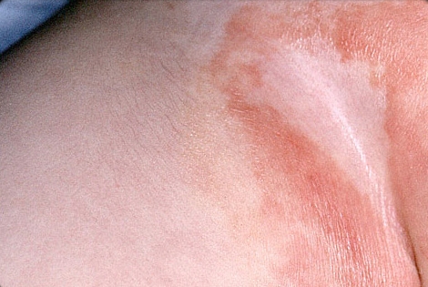 Dermatite da fralda